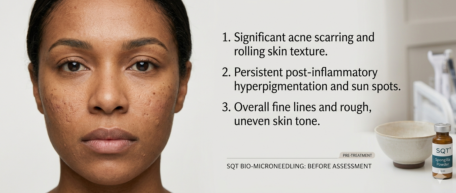 Before — SQT Bio Microneedling at GlowMed Aesthetics