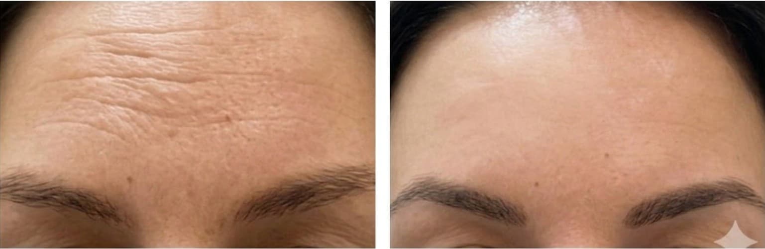 Before and after — Wrinkle Reduction at GlowMed Aesthetics Waterdown